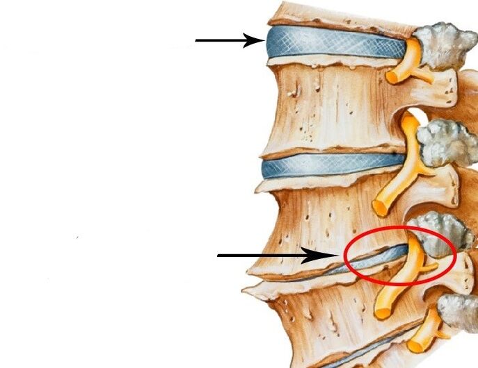 Hasarlı disk ve servikal osteokondroz ile ihlal edilen sinir