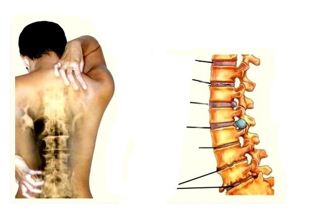Osteokondrozun gelişim aşamaları