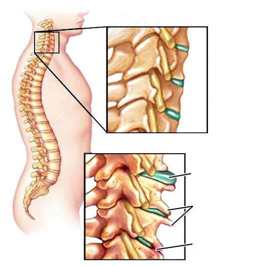 Sağlıklı omurga ve hasarlı osteokondroz