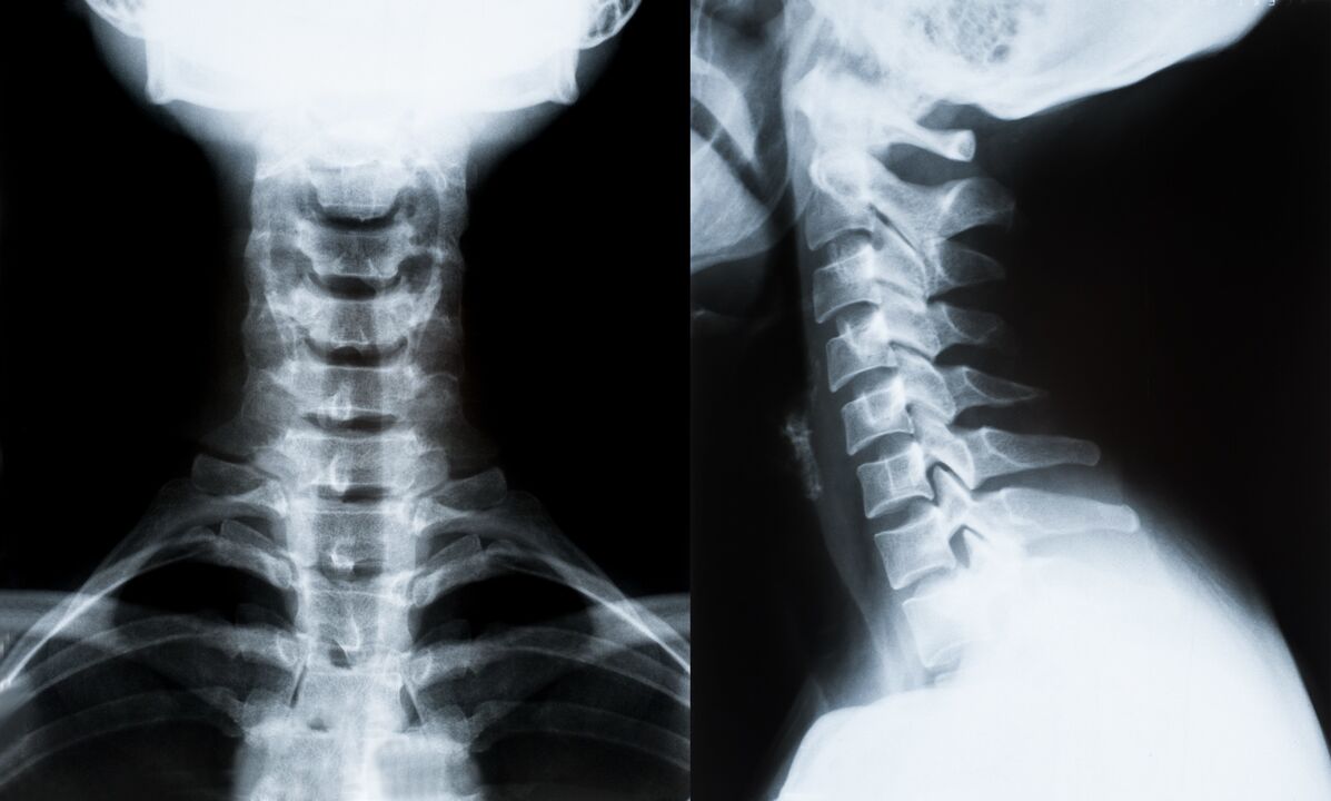 röntgende servikal osteokondroz